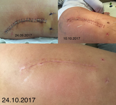 rehabilitacja blizny